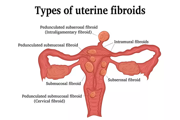 Fibroids during pregnancy are differentiated based on their location.