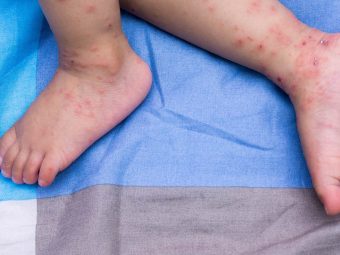6 Symptoms And Causes Of Hand, Foot And Mouth Disease In Babies