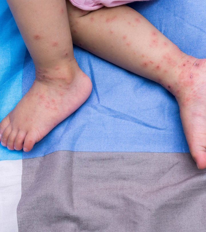 Hand Foot And Mouth Disease In Babies Causes Symptoms And Home Remedies