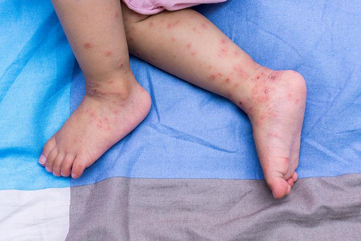 Hand Foot And Mouth Disease In Babies Causes Symptoms And Home Remedies