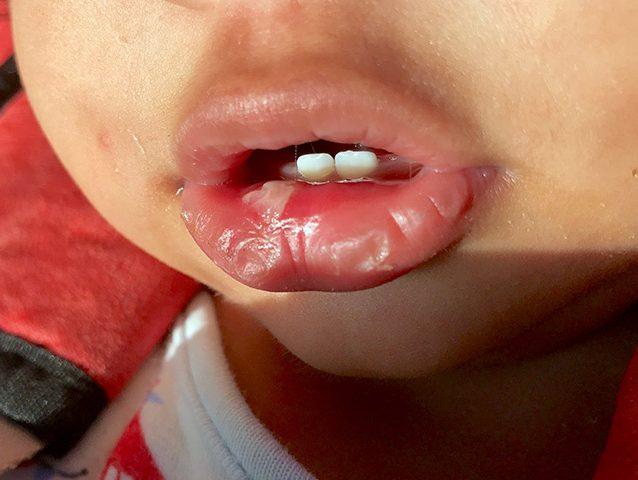 4-effective-treatments-to-cure-baby-s-mouth-ulcers