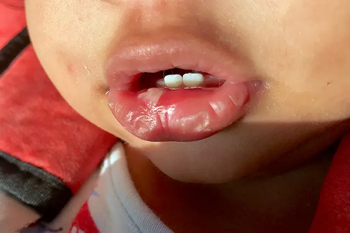 How to identify mouth ulcers in babies