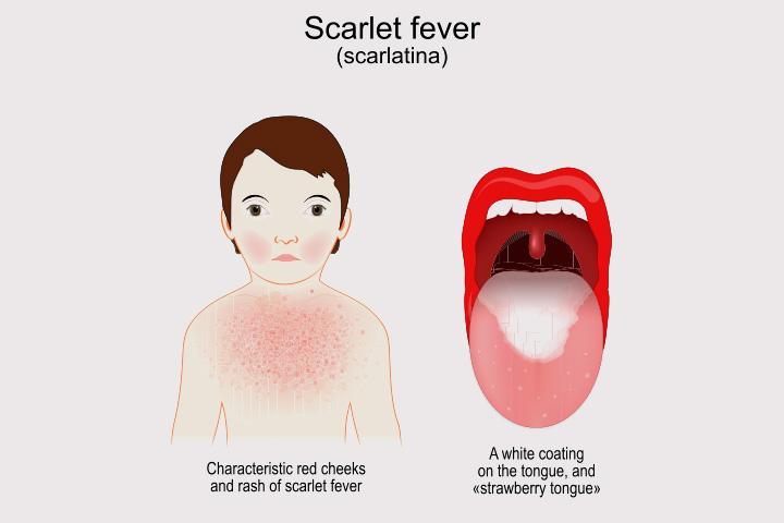 How to spot the symptoms of scarlet fever in your child