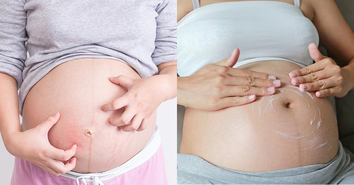 Itchy Belly During Pregnancy Causes Remedies And Treatment