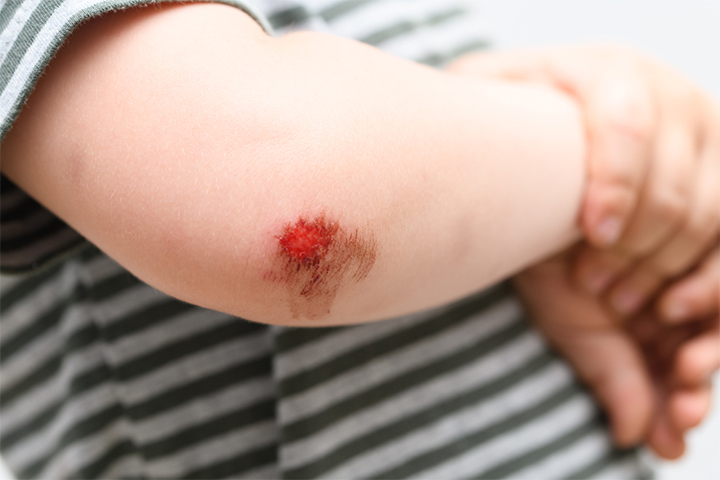 Keep the open wound clean to prevent staph infection in kids