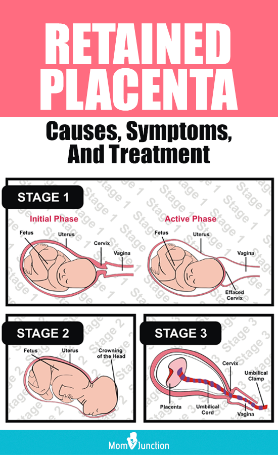 retained-placenta-causes-symptoms-and-treatment