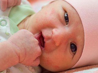 Scarlet Fever In Babies And Toddlers: 9 Answers You Must Know