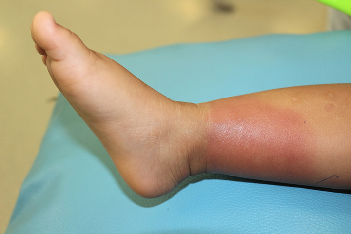 Skin infections are the most common staph infection in kids