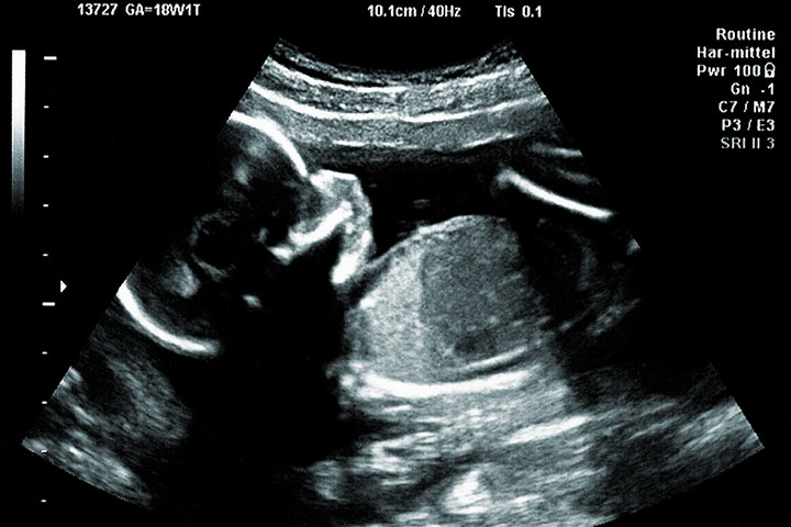 Ultrasound scan can tell the sex of a baby