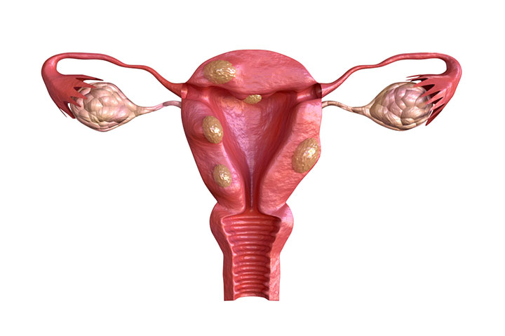 Uterine fibroids are non-cancerous tumors in the uterine region.