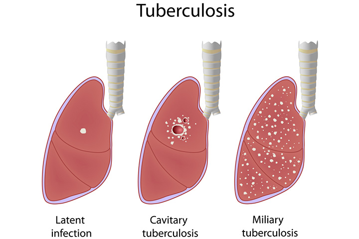 What Are The Types Of Tuberculosis