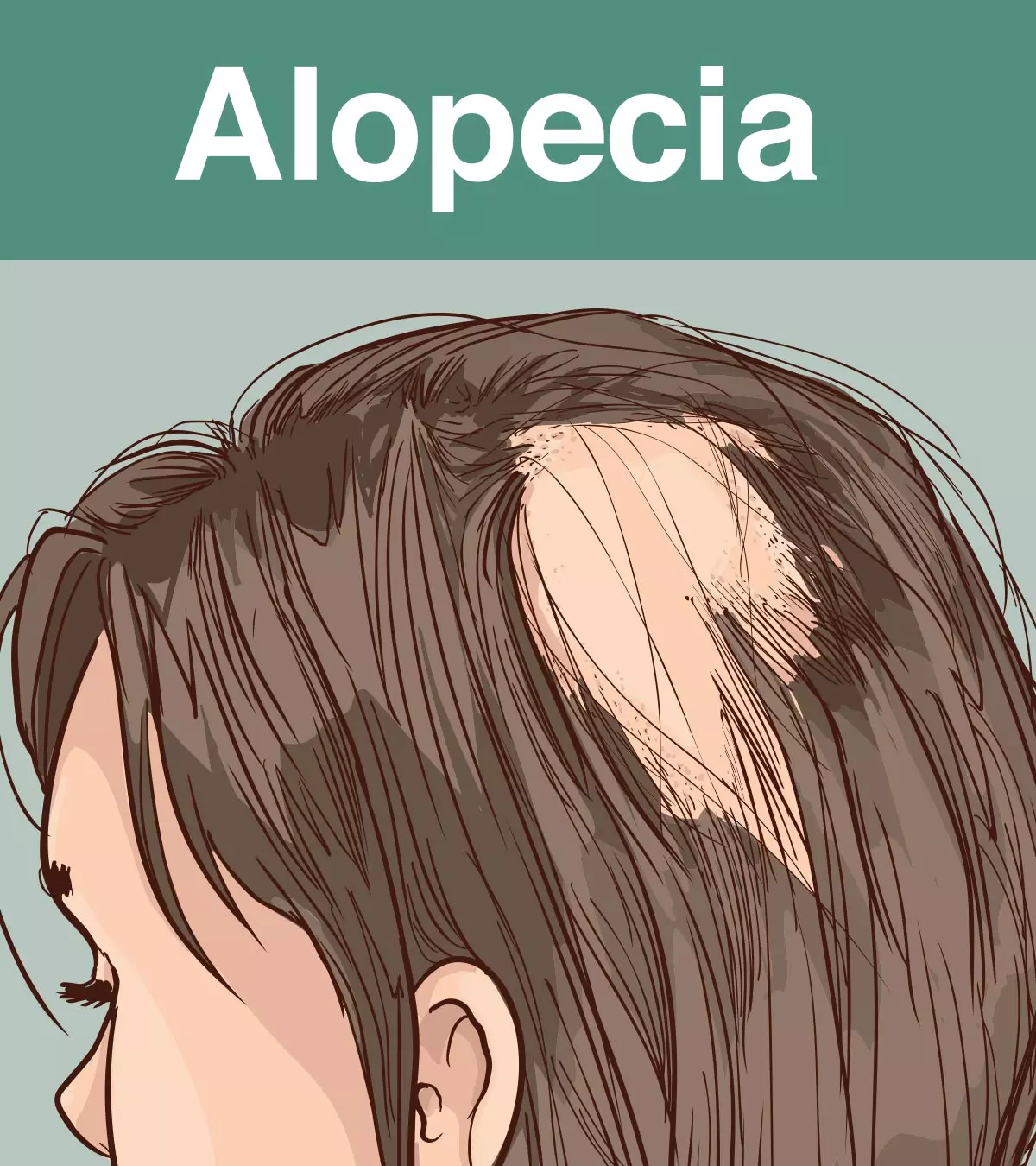 Alopecia In Children: Types, Symptoms, And Treatment_image