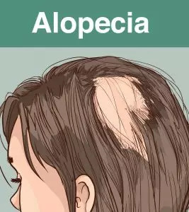 Alopecia In Children: Types, Symptoms, And Treatment