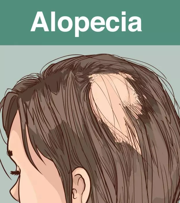 Alopecia In Children: Types, Symptoms, And Treatment
