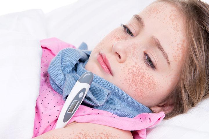 scarlet-fever-in-children-causes-symptoms-and-treatment