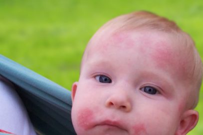 4 Causes Of Ringworm In Babies, Symptoms, And Treatment