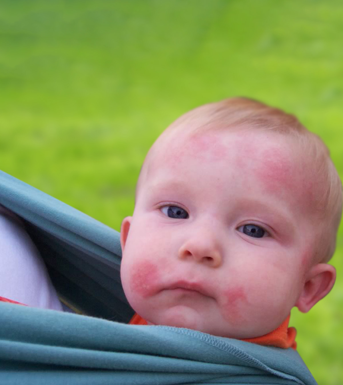 4 Causes Of Ringworm In Babies, Symptoms, And Treatment