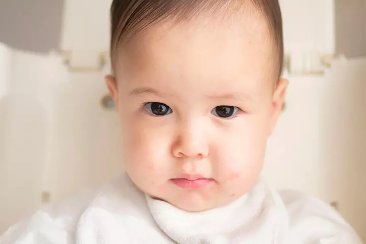 Babies may develop allergies around the mouth after eating kiwis.