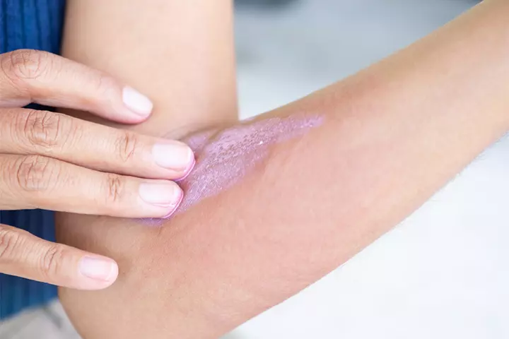 Calamine lotion can help alleviate itching