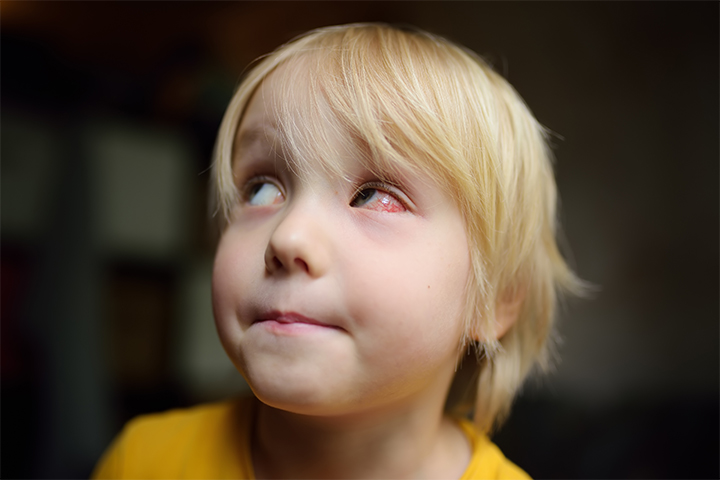 Chalazion in children can occur after conjunctivitis