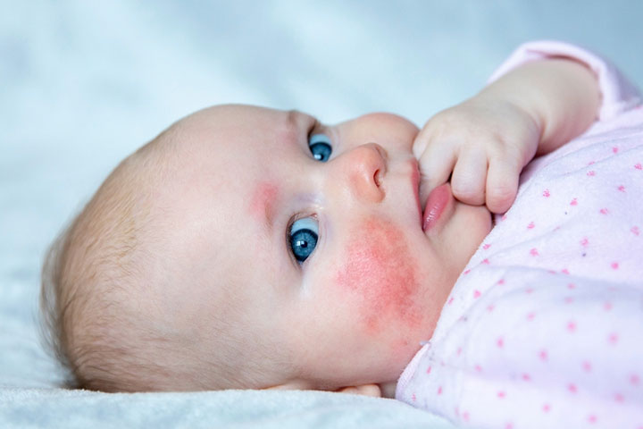 Consult a pediatrician when you notice rashes on the baby's body