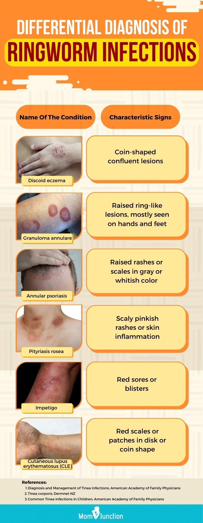 diagnoses of ringworm in babies(infographic)
