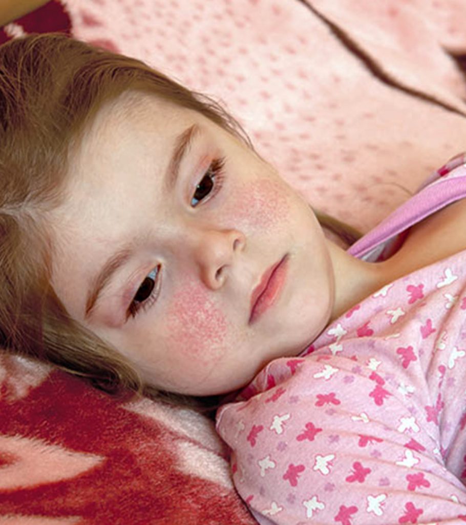 Fifth Disease In Children: Causes, Symptoms And Treatment