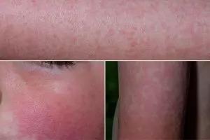 Fifth Disease In Children: Causes, Symptoms And Treatment