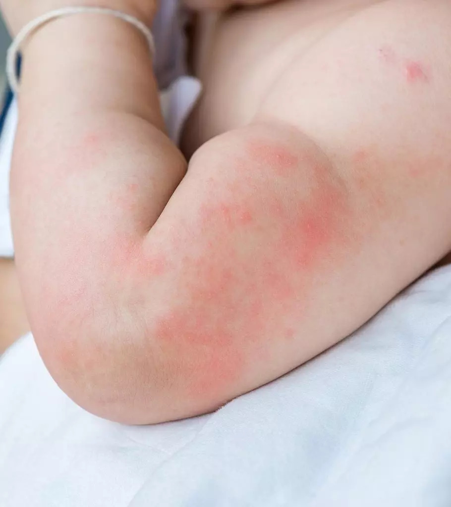 Top 97+ Images pictures of hives on baby Full HD, 2k, 4k