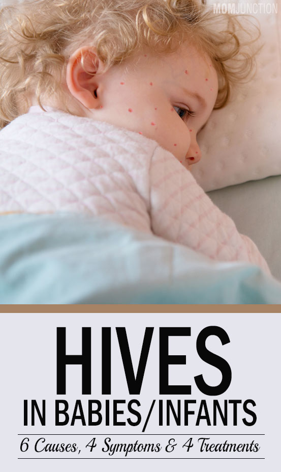 Hives In Babies Causes, Treatment & Home Remedies