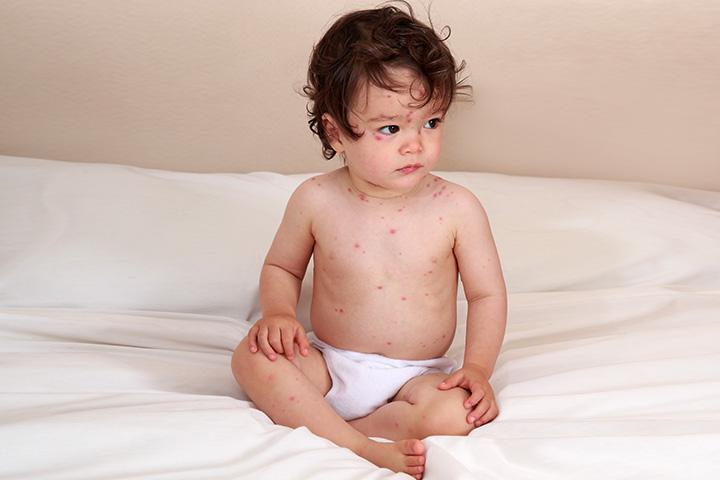 hives-in-toddlers-5-causes-5-symptoms-3-treatments-you-should-be