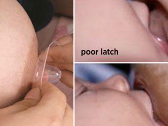 Nipple Shield: How And When To Use Them