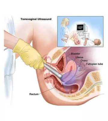 Is-It-Safe-To-Have-A-Transvaginal-Scan-During-Pregnancy
