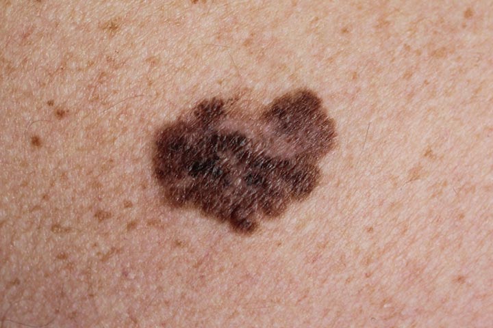 Melanoma appears as a new mole or changes existing mole into a cancerous one