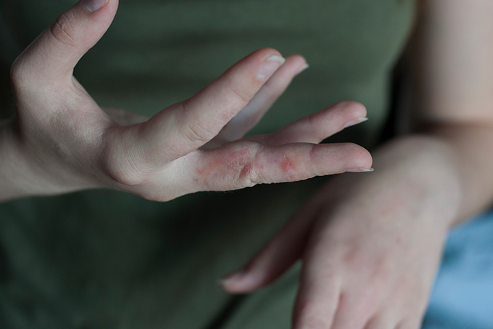 Scabies can cause body odor in teens