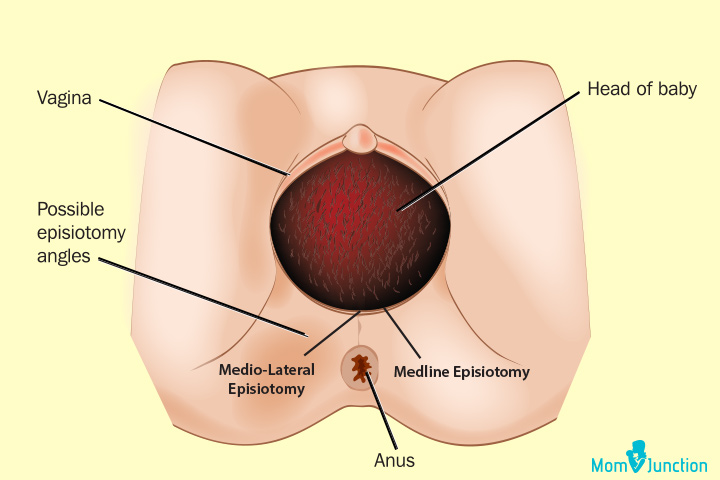 What Is Episiotomy And How To Take Care After Delivery