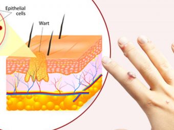 12 Symptoms and Effective Treatments of Warts In Children