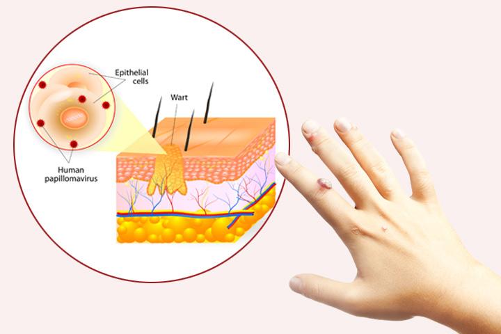 Wart Chart