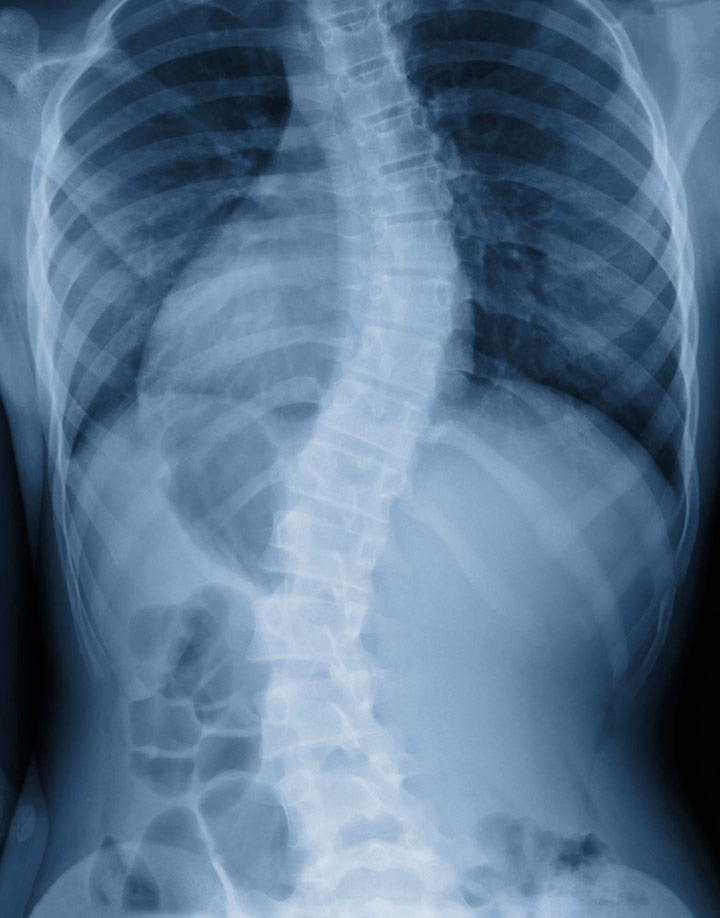 Scoliosis In Children: What Causes It And How To Treat