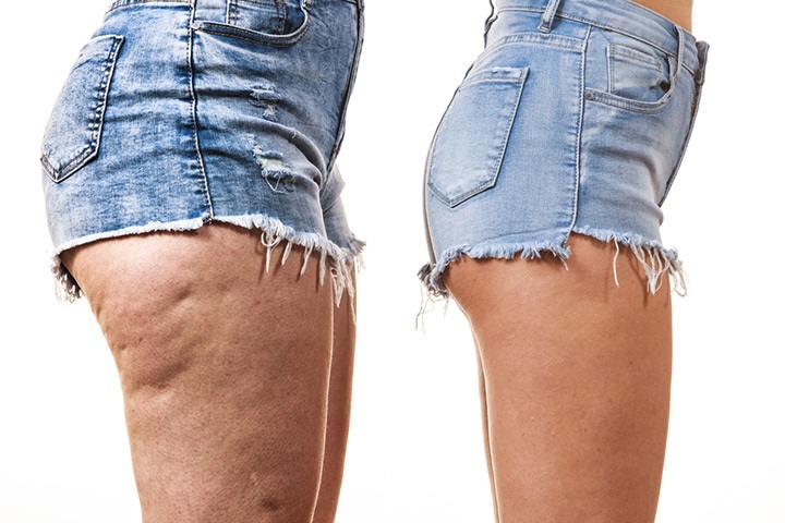 What Is Cellulite On Legs