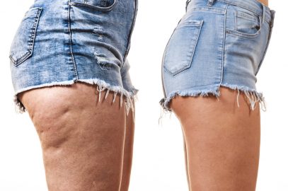 Cellulite In Teens: Causes And Treatment Options To Get Rid Of It
