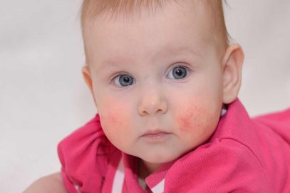 Food Allergies In Babies: Signs, Symptoms And Treatment