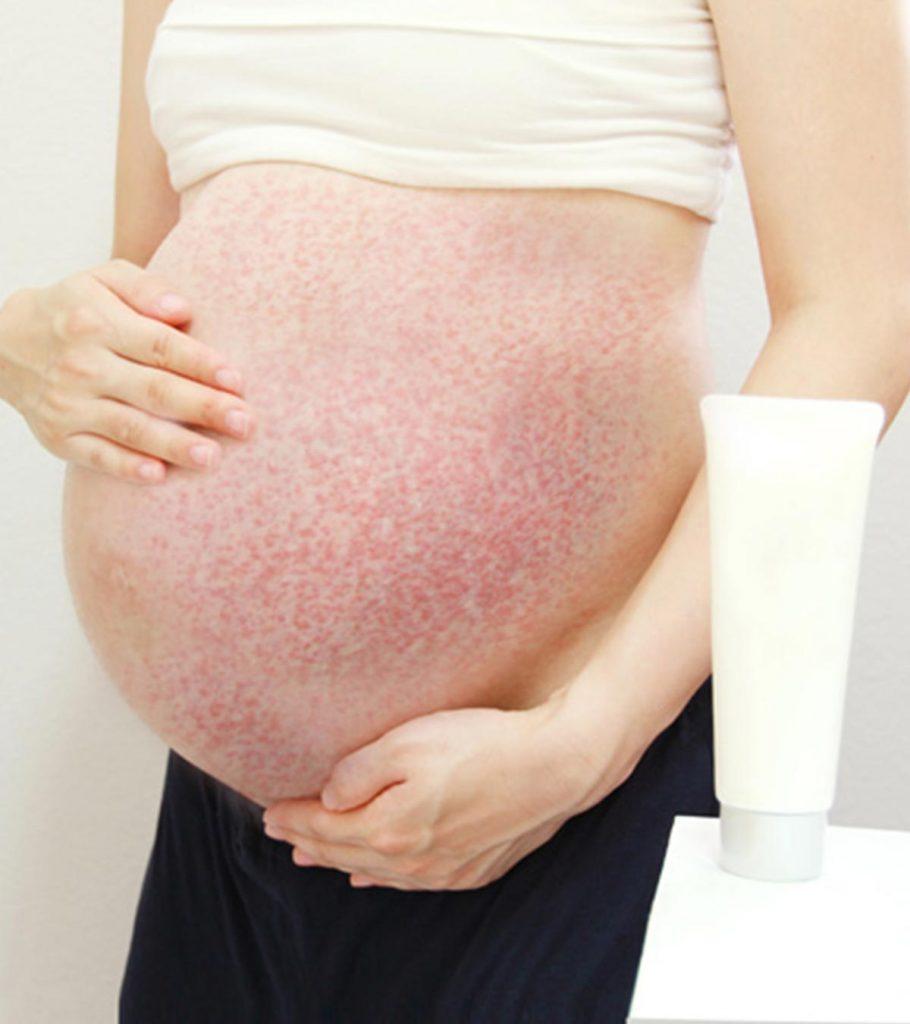 Can You Have Rashes During Pregnancy