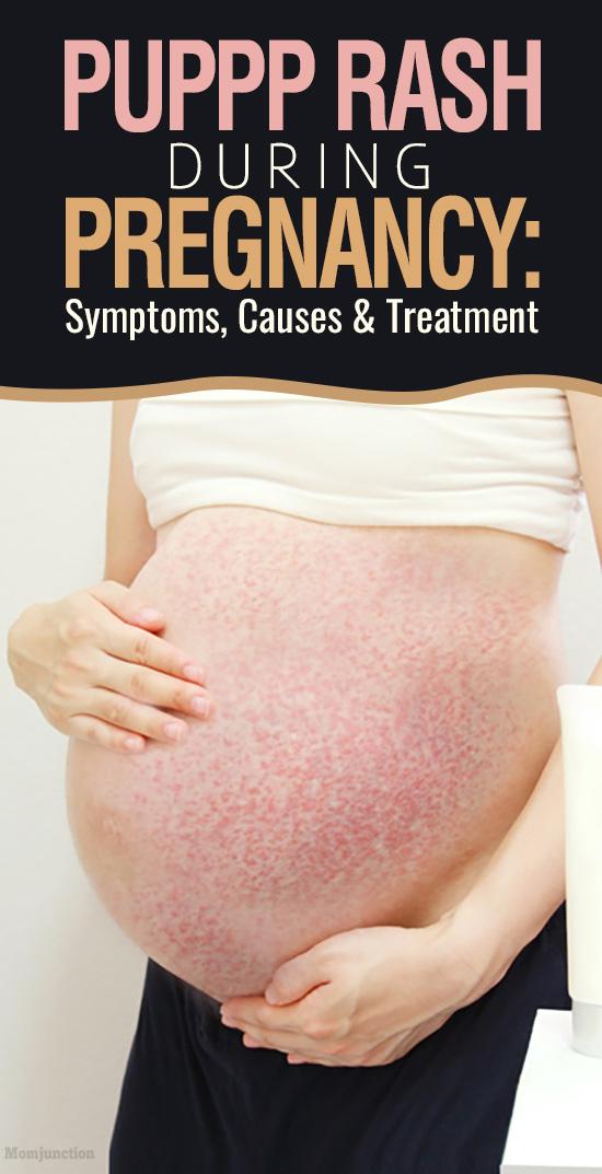 PUPPP Rash In Pregnancy Prevention Treatment And Remedies