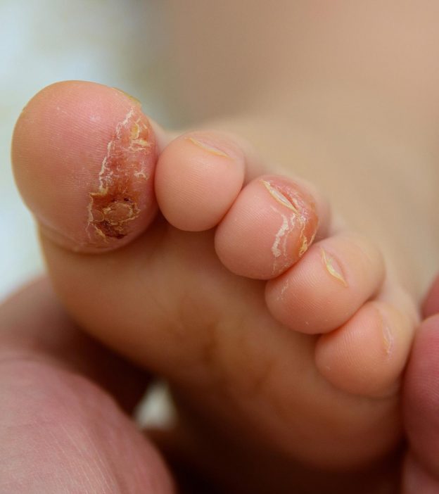 Baby Psoriasis: Symptoms, Causes, Treatment & Complications
