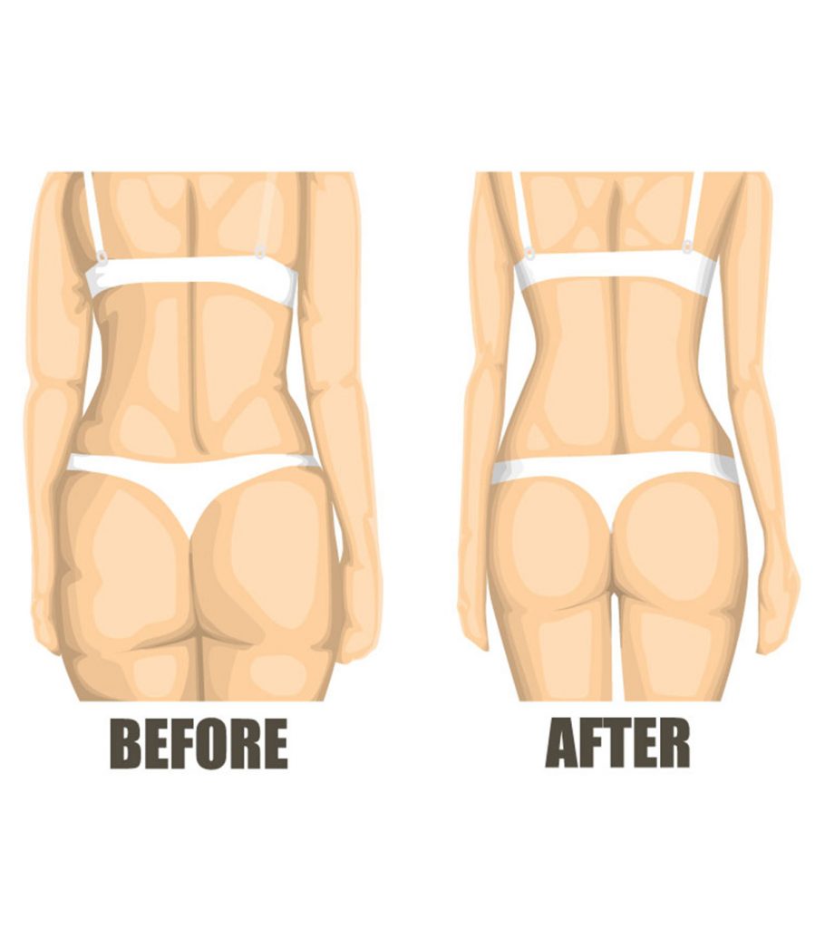 5 Effective Treatments To Cure Cellulite In Teens