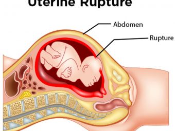 Uterine Rupture: Causes, Symptoms, And Treatment
