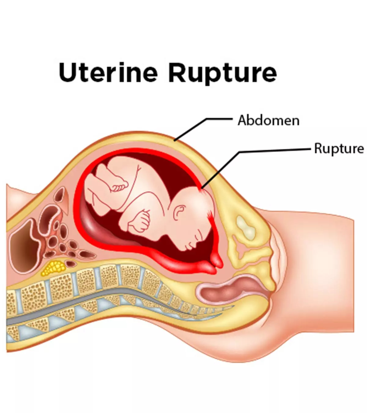 Pressure on the uterus wall can cause rupture and can be associated with pain and vaginal bleeding.