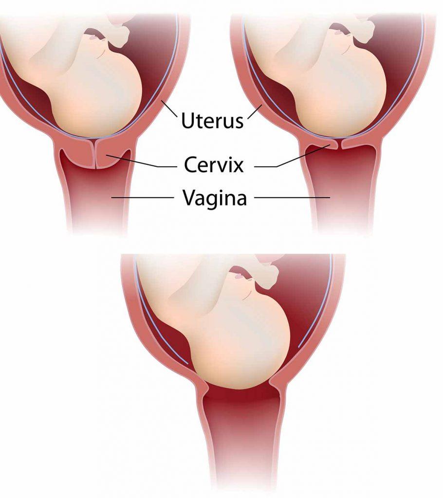 8 Cervix Changes During Birth Or Labor And Complications