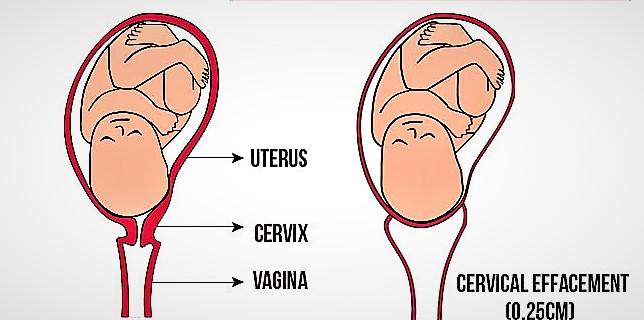 Can Cervix Length Changes During Pregnancy